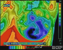 2 Years Post-Cryoablation Thermogram