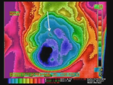 3 Months Pre-Cryoablation Thermogram