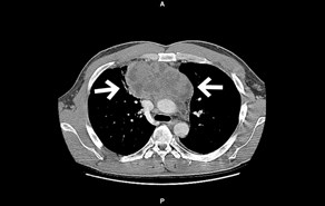 X-Ray of cancer tumor